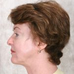 After Mesolipotherapy 