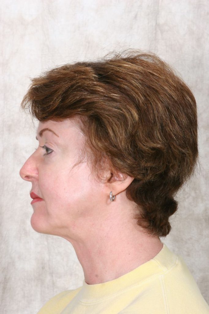 After Mesolipotherapy
