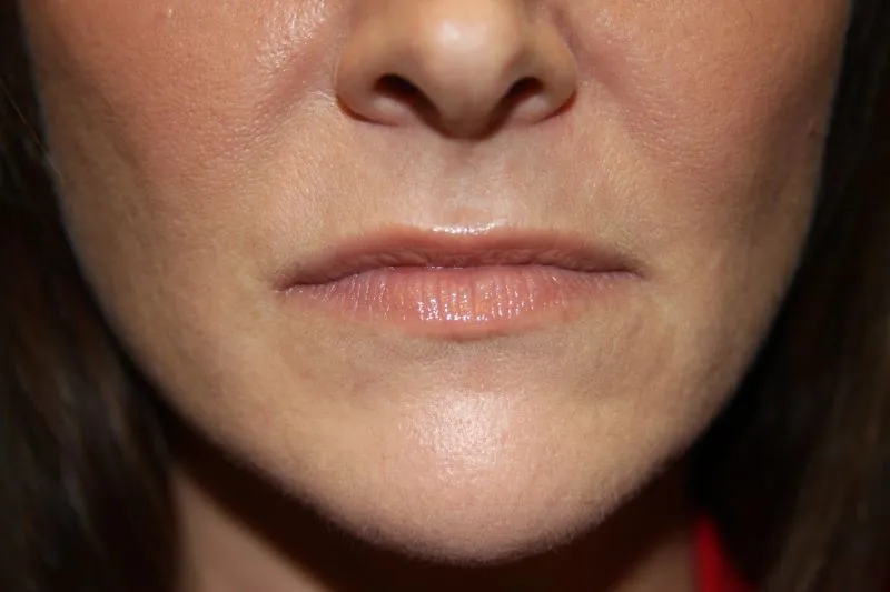 Before Lip Injection