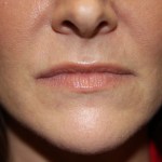 Before Lip Injection