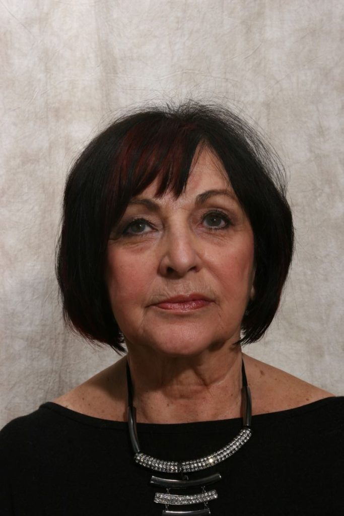 3 years after sculptra