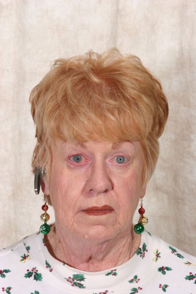 After the correction of drooping eyelids