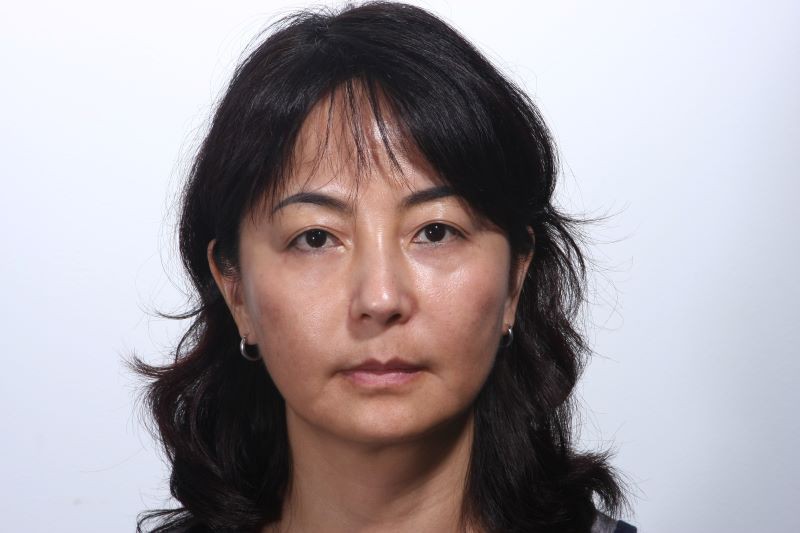 6 years after sculptra