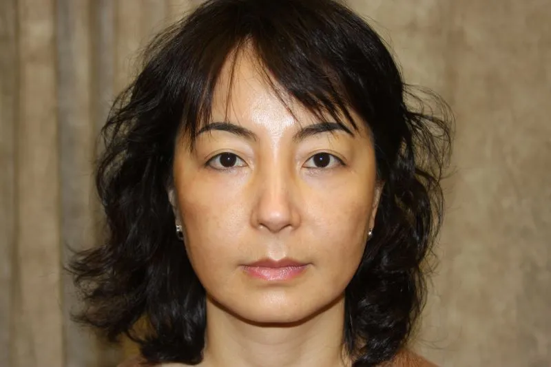 2 years after sculptra