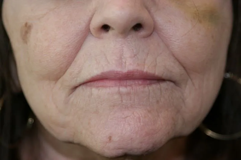 A woman's lips before SILIKON 1000