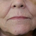 A woman's lips before SILIKON 1000