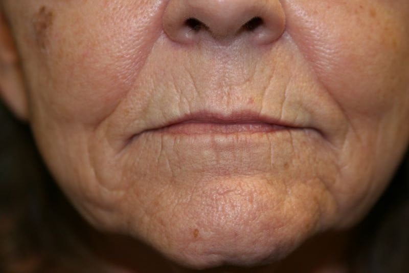 A woman's lips before SILIKON 1000