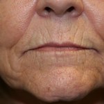 A woman's lips before SILIKON 1000