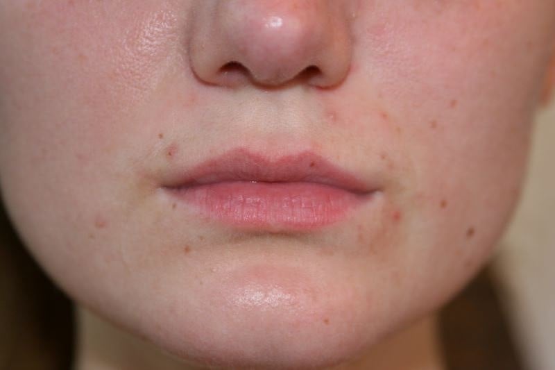 A woman's lips after SILIKON 1000