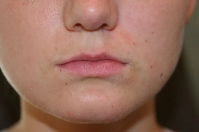 A woman's lips before SILIKON 1000