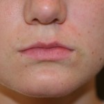 A woman's lips before SILIKON 1000