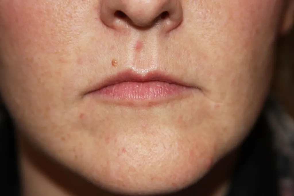 A woman's lips before SILIKON 1000