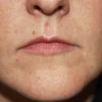 A woman's lips before SILIKON 1000