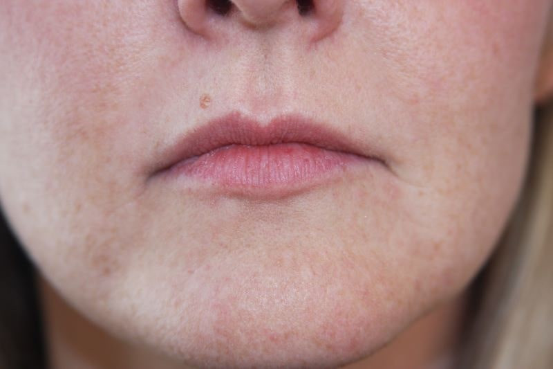 A woman's lips after SILIKON 1000