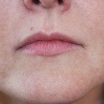 A woman's lips after SILIKON 1000