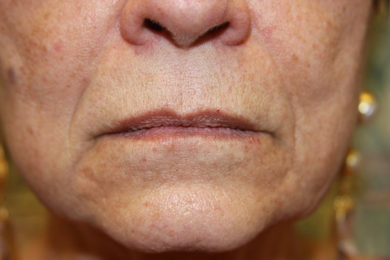 A woman's lips before SILIKON 1000