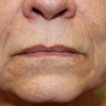 A woman's lips before SILIKON 1000