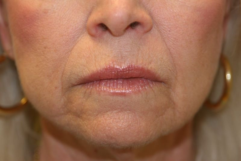 A woman's lips after SILIKON 1000