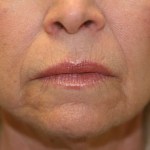A woman's lips after SILIKON 1000