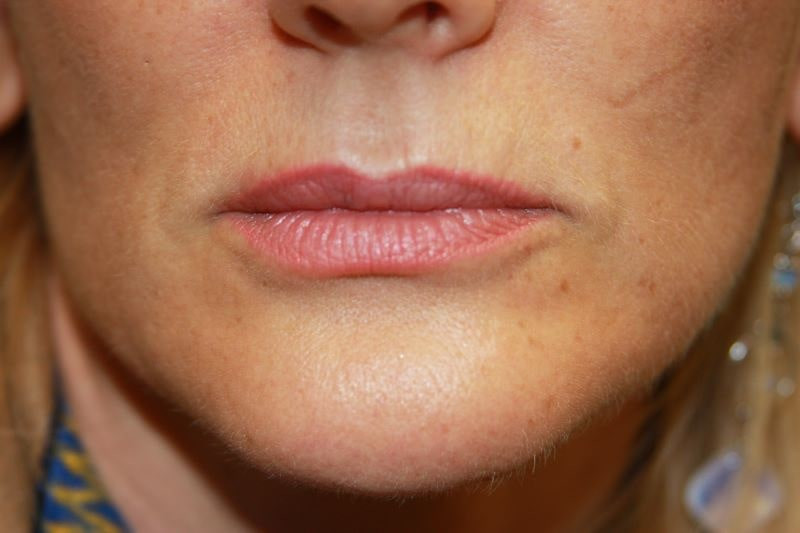 A woman's lips before SILIKON 1000