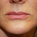 A woman's lips before SILIKON 1000