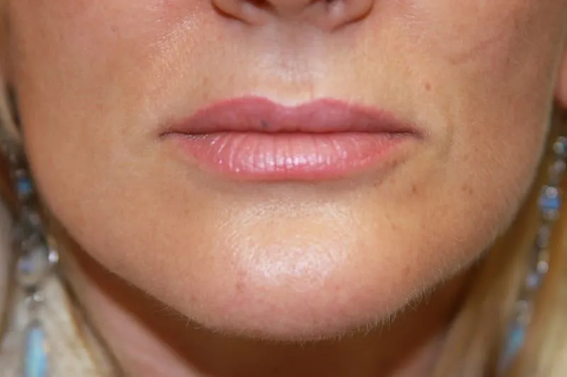 A woman's lips after SILIKON 1000