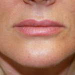 A woman's lips after SILIKON 1000