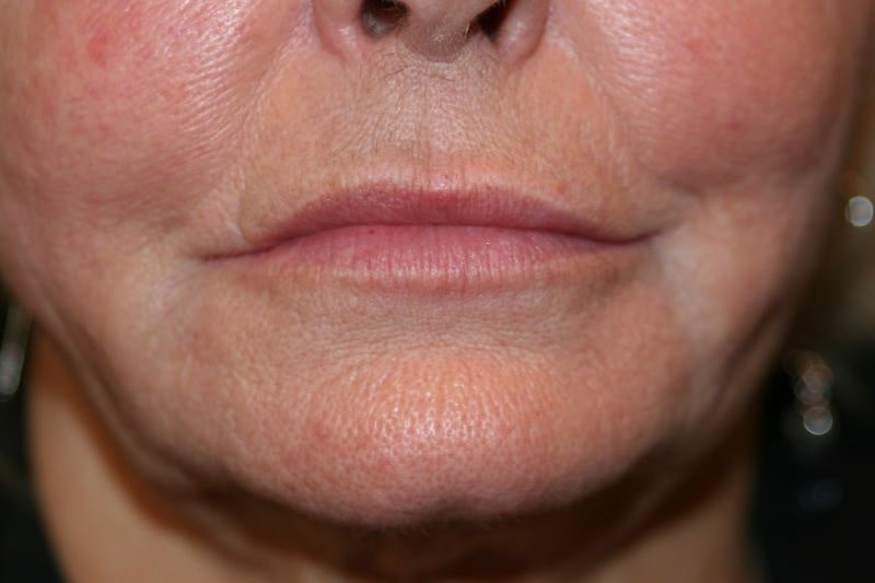 A woman's lips after SILIKON 1000
