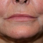 A woman's lips after SILIKON 1000