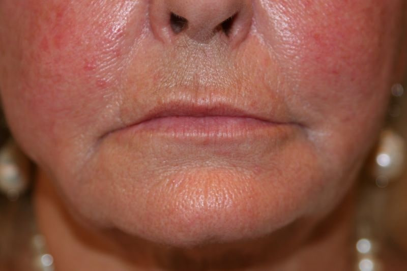 A woman's lips before SILIKON 1000