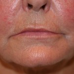 A woman's lips before SILIKON 1000