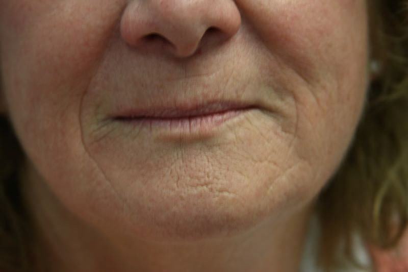 A woman's lips before SILIKON 1000