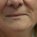 A woman's lips before SILIKON 1000