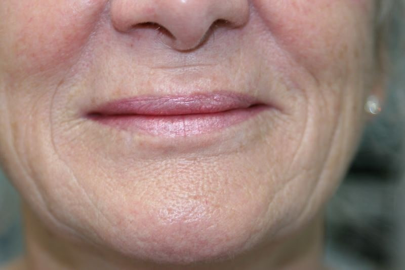 A woman's lips after SILIKON 1000