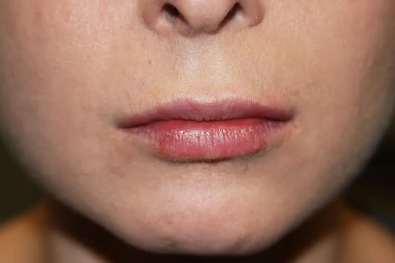 A woman's lips after SILIKON 1000