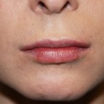 A woman's lips after SILIKON 1000