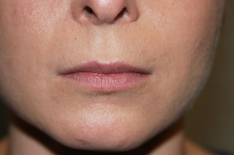 A woman's lips before SILIKON 1000