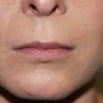 A woman's lips before SILIKON 1000