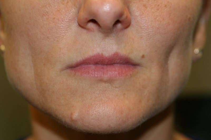 A woman's lips before SILIKON 1000