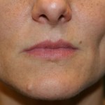 A woman's lips before SILIKON 1000