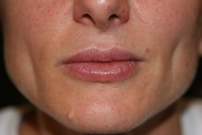 A woman's lips after SILIKON 1000