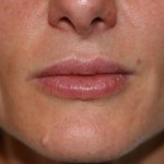 A woman's lips after SILIKON 1000