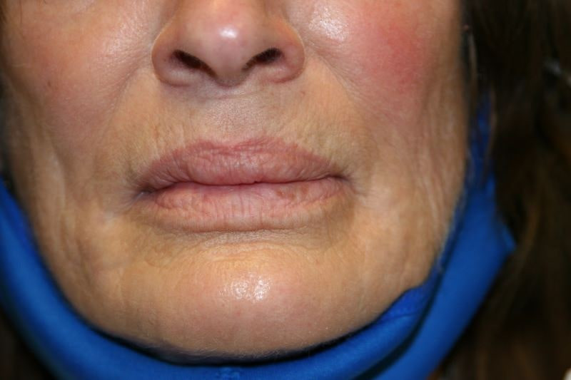 A woman's lips after SILIKON 1000