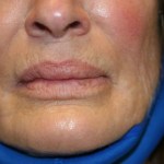 A woman's lips after SILIKON 1000
