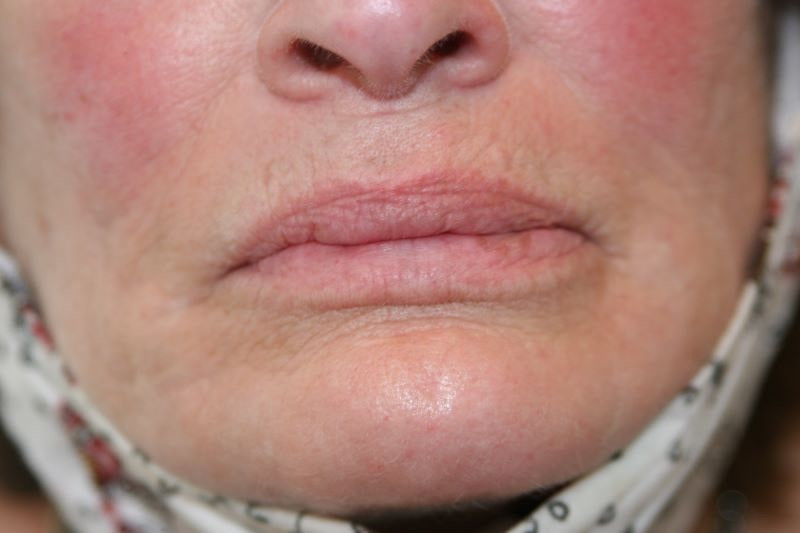 A woman's lips after SILIKON 1000