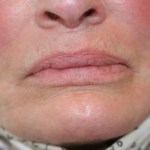 A woman's lips after SILIKON 1000