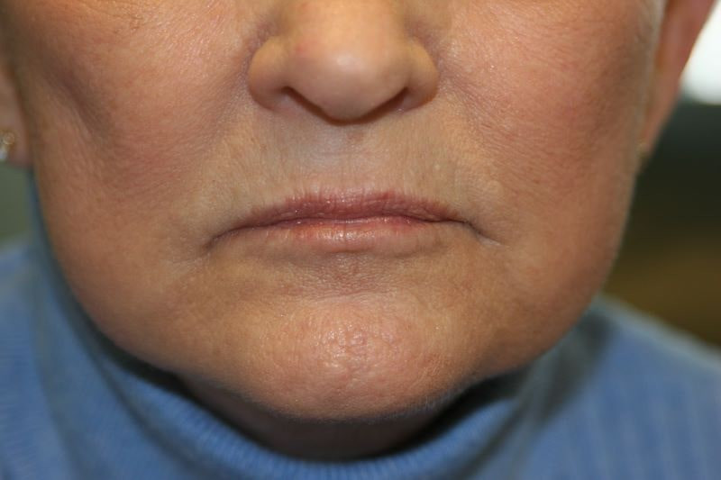 A woman's lips before SILIKON 1000