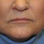 A woman's lips before SILIKON 1000