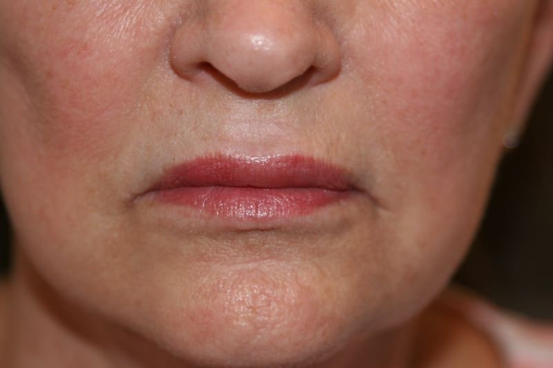 A woman's lips after SILIKON 1000