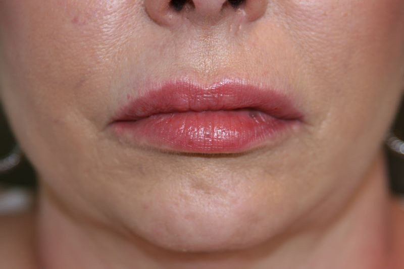 A woman's lips after SILIKON 1000